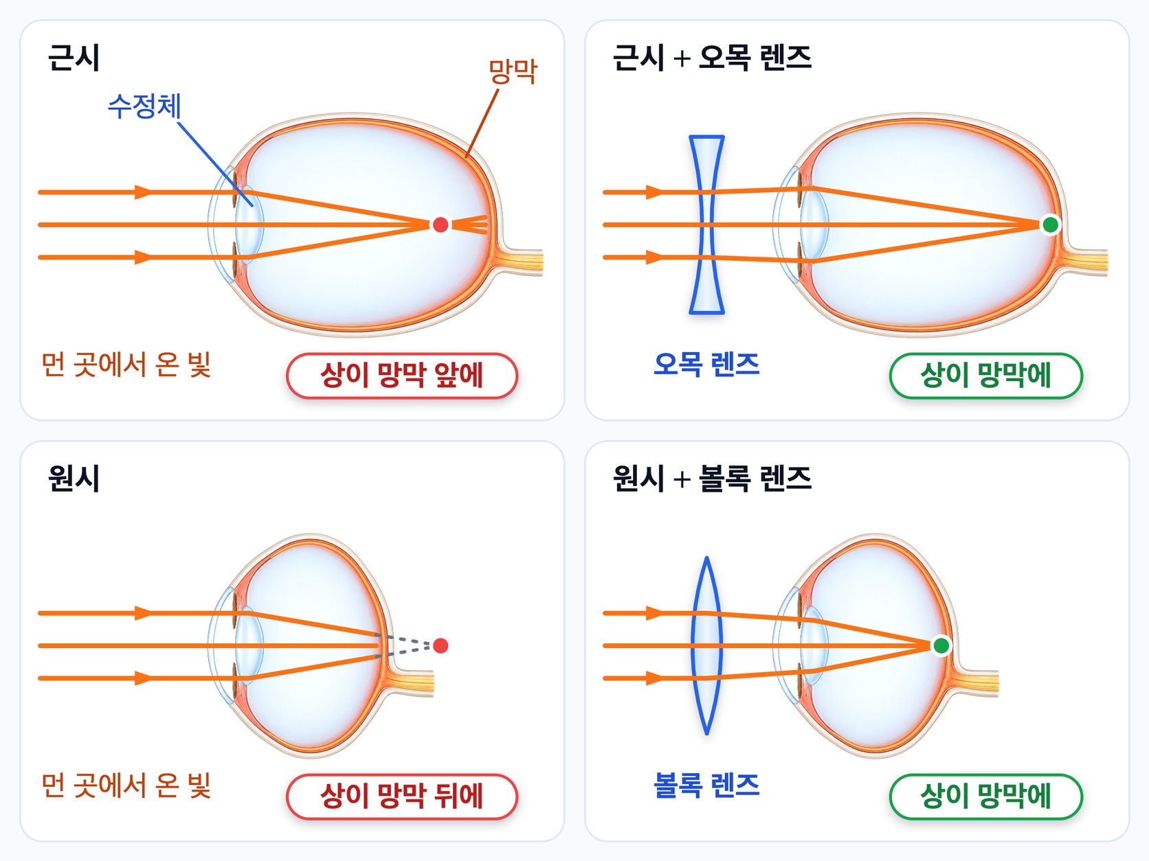 근시와 원시의 교정 — 근시는 상이 망막 앞에 맺혀 오목 렌즈로 빛을 퍼뜨려 교정하고, 원시는 상이 망막 뒤에 맺혀 볼록 렌즈로 빛을 모아 교정한다